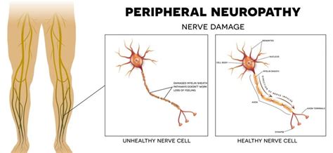 Peripheral Neuropathy Definition, Types and Treatment Options – Makai ...