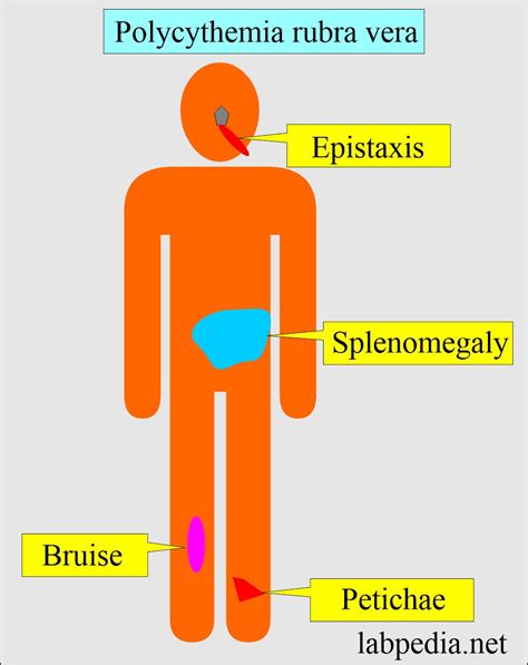 Polycythemia (Erythrocytosis), Polycythemia Rubra Vera, and Secondary Polycythemia - Labpedia.net