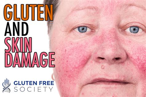 dermatitis herpetiformis – Gluten Free Society