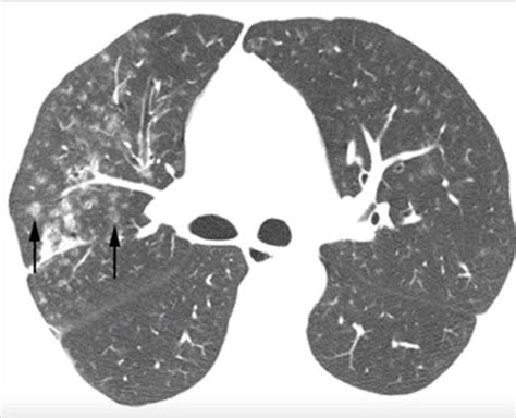 Nodules – Centrilobular | Lungs