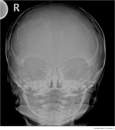 Neonatal lacunar skull as an isolated finding | Anales de Pediatría