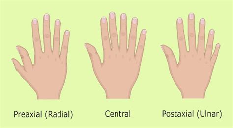 Polydactyly (Extra Fingers) In Babies: Causes And Treatment