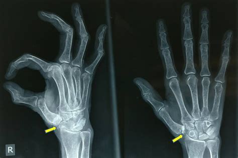 Cureus | First Carpo-metacarpal Joint Arthritis: Interpositional Arthroplasty using Trapezium