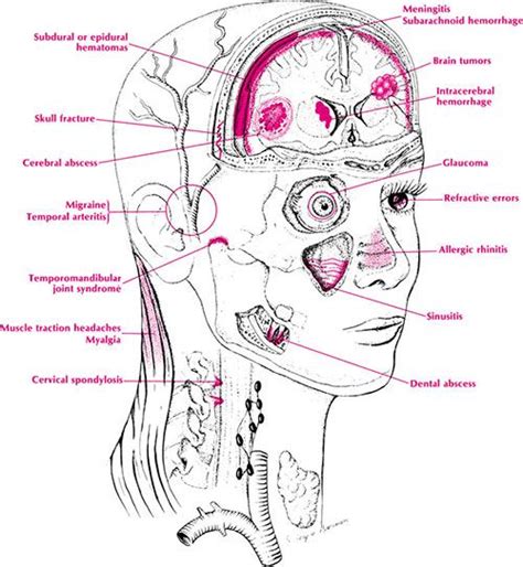 headache - Google Search Migraines Remedies, Migraine Headaches ...