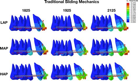 Initial movement of maxillary anterior teeth and archwire deformation... | Download Scientific ...