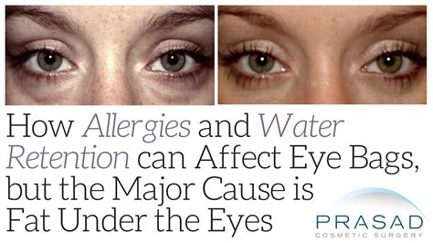 How Allergies and Water Retention can Affect Eye Bags, but the Major Cause is Fat Under the Eyes ...