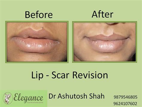 Lip Scar Revision Surgery, Valsad, Gujarat, India.