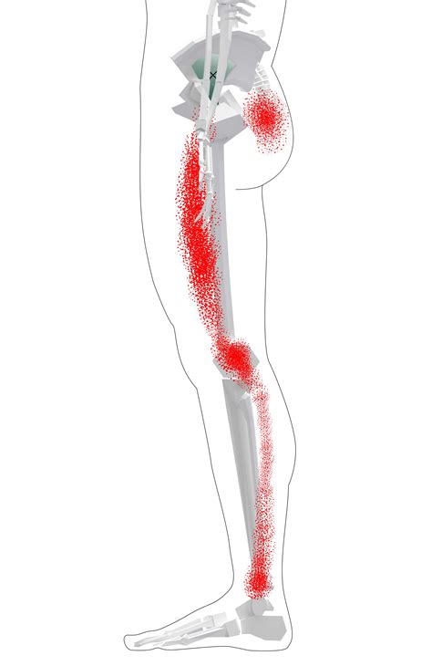 Gluteus Minimus Trigger Points (Overview - Self Treatment Tips)