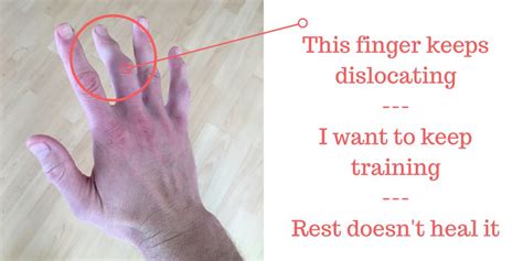 Finger Dislocation Treatment and Recovery (My Experience) - Injury Health Blog