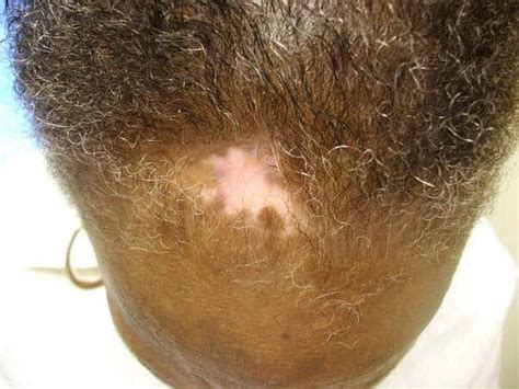 How to Stop Lupus Hair Loss- In the video below: