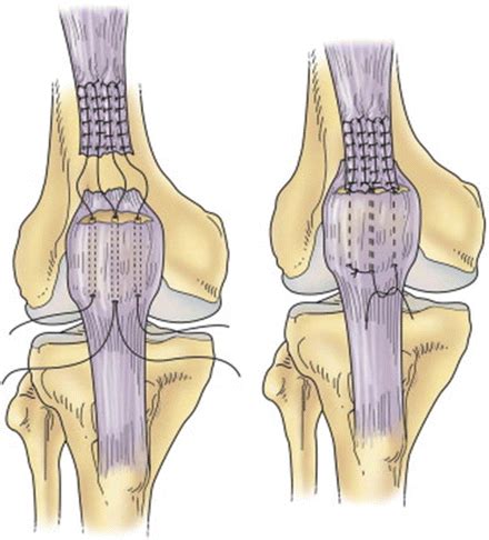 Quadriceps Tendon Ruptures | Musculoskeletal Key