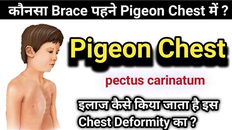 What is Pigeon chest ? - Physio talk official