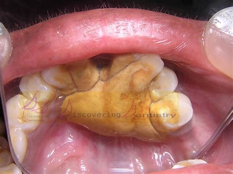 Dental calculus; Tartar