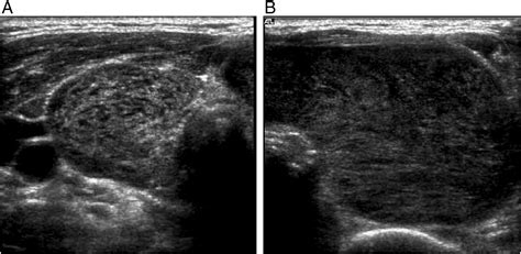 Ultrasound of primary thyroid non-Hodgkin's lymphoma - Clinical Imaging