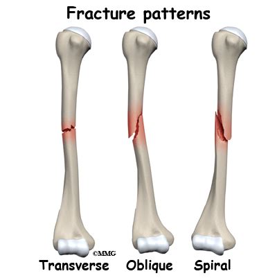 Adult Humerus Shaft Fractures - Midwest Bone and Joint Institute