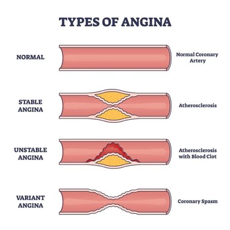 Angina Treatment & Symptoms, The Causes of Angina