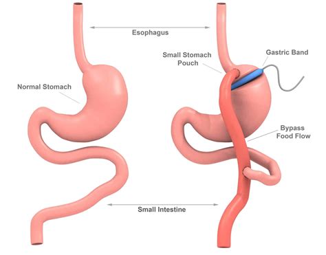 Weight-Loss Procedures | What are Weight-Loss Surgery Requirements? (UPDATE: Jul 2018) | 11 ...