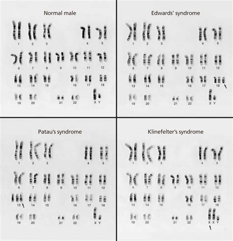 Awasome Biology Karyotype Worksheet Answer Key Pdf 2023 › Athens Mutual ...