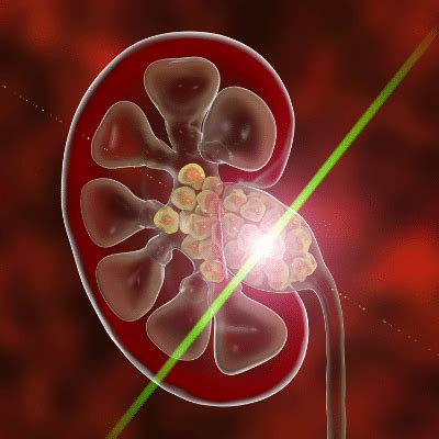 Chronic Kidney Stones Explained - Richmond Nephrology Associates