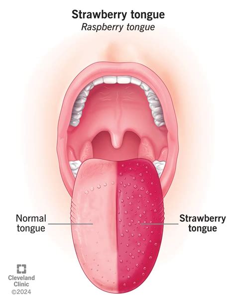 Strawberry Tongue: Causes & Treatment