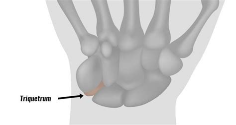 Triquetrum Fracture - Symptoms, Causes & Treatment.