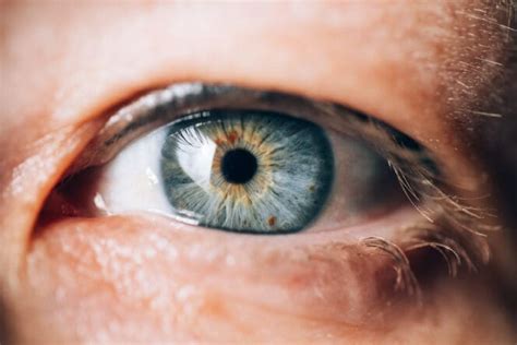 Causes and Treatment of Brown Spots on Eyes (Nevi) | MyVision.org