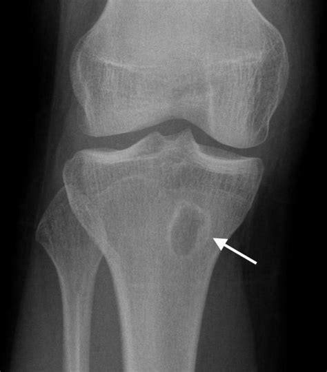 Brodie abscess | Radiology Case | Radiopaedia.org | Radiology ...