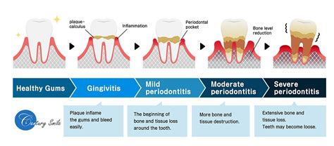 The Stages Of Periodontal Disease Cartoon Vector Cart - vrogue.co