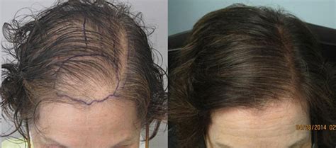 Womens Before and After Hair Transplant Photos