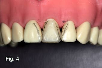 Primary Anatomy for Anterior Provisionals - Spear Education