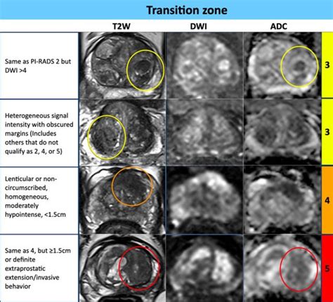 The Radiology Assistant : Prostate Cancer - PI-RADS v2.1