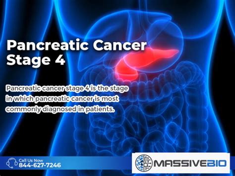 Pancreatic Cancer Stage 4 - Symptoms, Treatment, and Survival