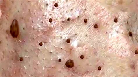 The Most Oddly Satisfying Blackhead Extraction Video - YouTube