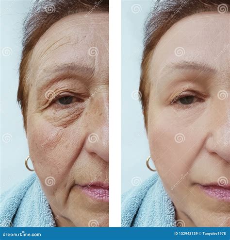 Old Woman Wrinkles before and after Medicine Correction Cosmetology ...