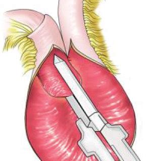 Construction of a Kock pouch reservoir. | Download Scientific Diagram