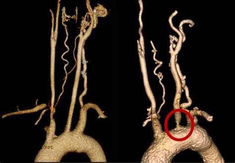 Disease progression of Takayasu arteritis in two patients treated with ...