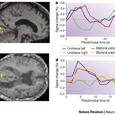 (PDF) Neural correlates of consciousness in humans