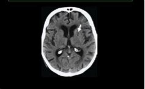 Lacunar Infarct - Symptoms, What is?, Causes, Treatment