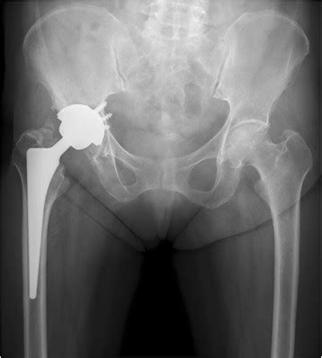 Radiograph taken at the 3-year follow-up of total hip arthroplasty (8 ...