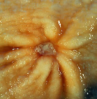 File:Benign gastric ulcer 1.jpg - Wikimedia Commons