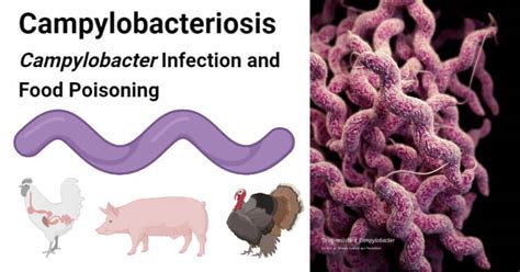 Campylobacteriosis- Campylobacter Infection and Food Poisoning