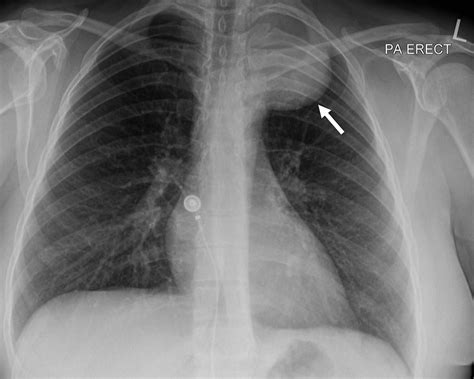 Cureus | Schwannoma: A Rare Etiology of Pancoast Syndrome