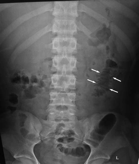 Acute Pancreatitis X Ray Sentinel Loop Online | aria-database.com