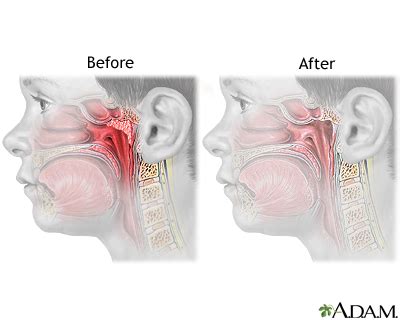 Adenoid removal - series—Aftercare: MedlinePlus Medical Encyclopedia