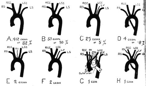 Image of variations in mode of origin of branches of aortic arch