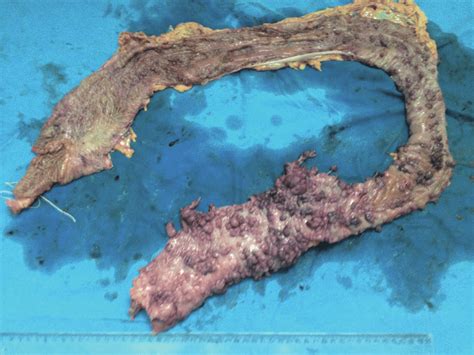 Adenocarcinoma developed on a tubulo-villous adenoma located at the... | Download Scientific Diagram