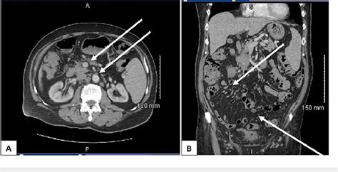 CT scan demonstrating the diffuse pelvic lymphadenopathy. The ...