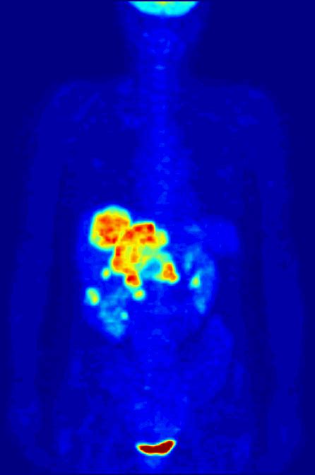 What Is a PET Scan? - Definition, Uses & Side Effects | Study.com