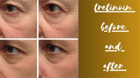 Tretinoin Before and After: A Transformational Journey