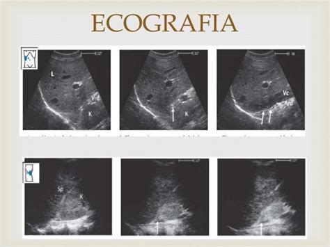 Enfermedades de glandulas suprarrenales